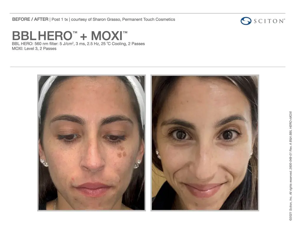 Before and after Moxi BBL Hero Treatment | Bloom Aesthetics | Bend and McMinnville, OR