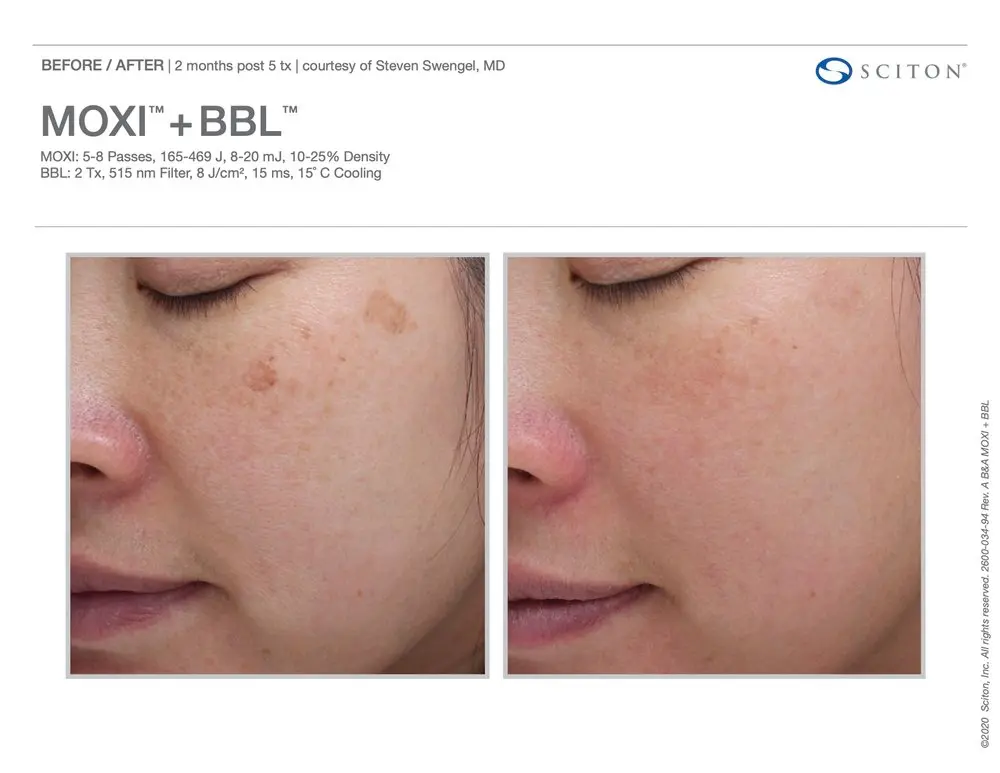 Before and after Moxi BBL Treatment | Bloom Aesthetics | Bend and McMinnville, OR