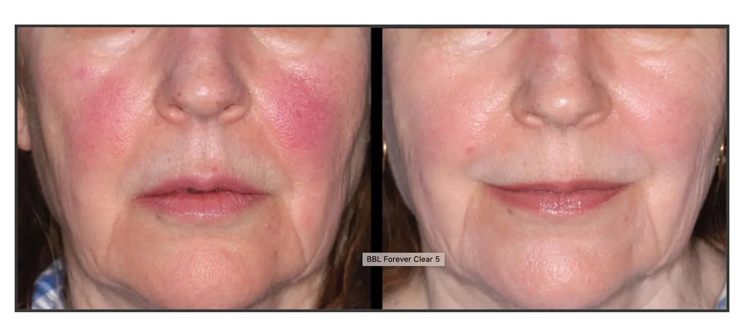 Before and after BBL Forever Young Treatment | Bloom Aesthetics | Bend and McMinnville, OR