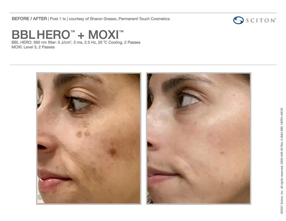 Before and after Moxi BBL Hero Treatment | Bloom Aesthetics | Bend and McMinnville, OR