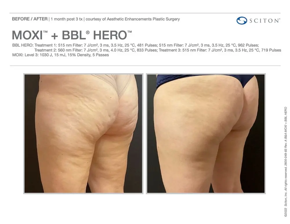 Before and after Moxi BBL Hero Treatment | Bloom Aesthetics | Bend and McMinnville, OR