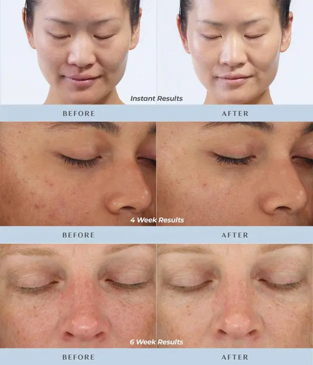 before-after | DiamondGlow Facial in Bend, OR