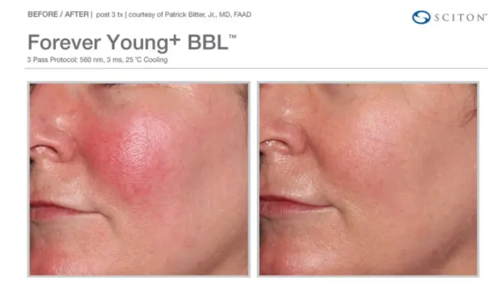 Before and after BBL Forever Young Treatment | Bloom Aesthetics | Bend and McMinnville, OR