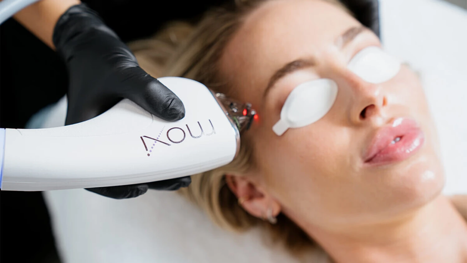 Moxi laser Treatment | Bloom Aesthetics | Bend and McMinnville, OR