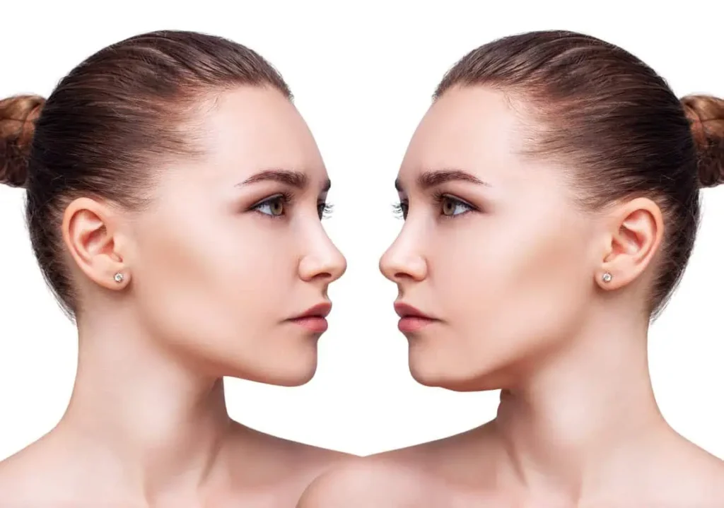 Kybella Treatment