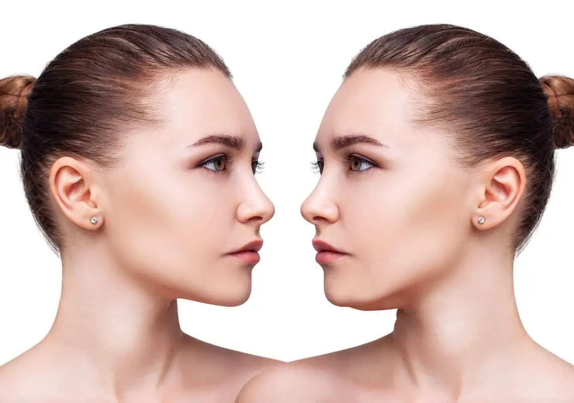 Expert Tips for Maximizing Results After Your Kybella Treatment