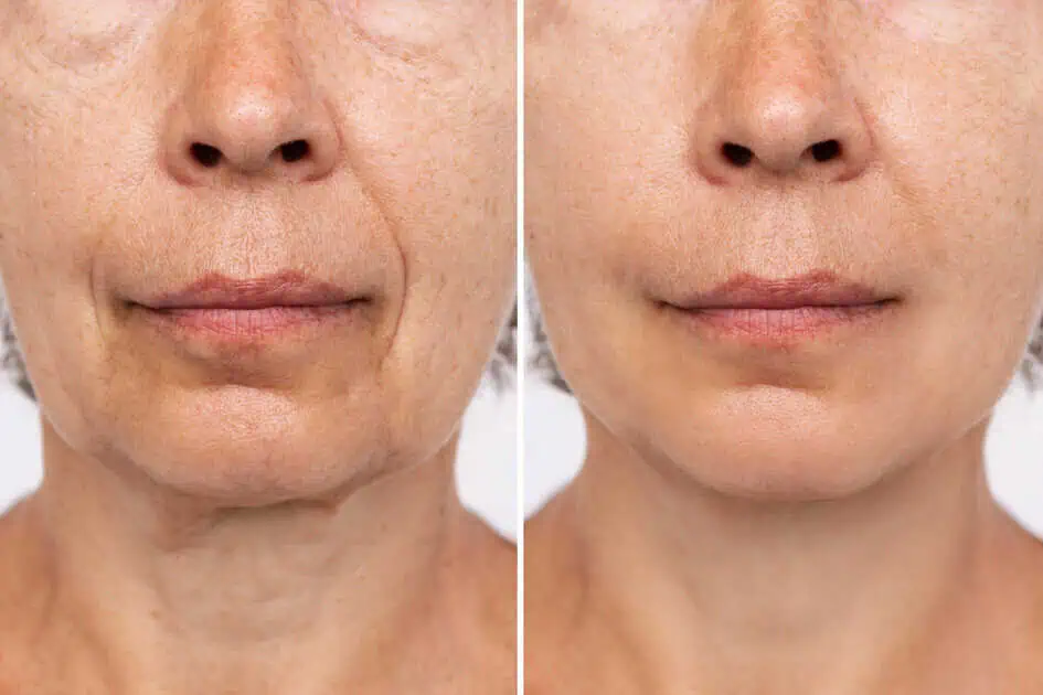 Sculptra: The Non-Surgical Solution for a Younger-Looking Face